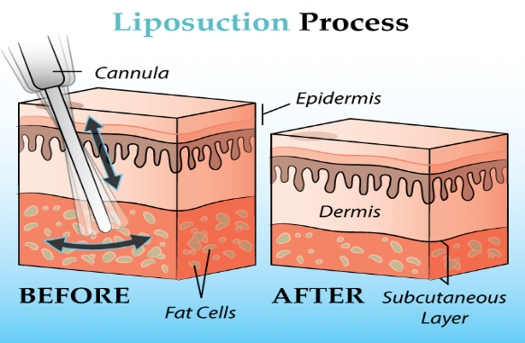 Liposuction process